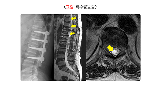 안산척추수술