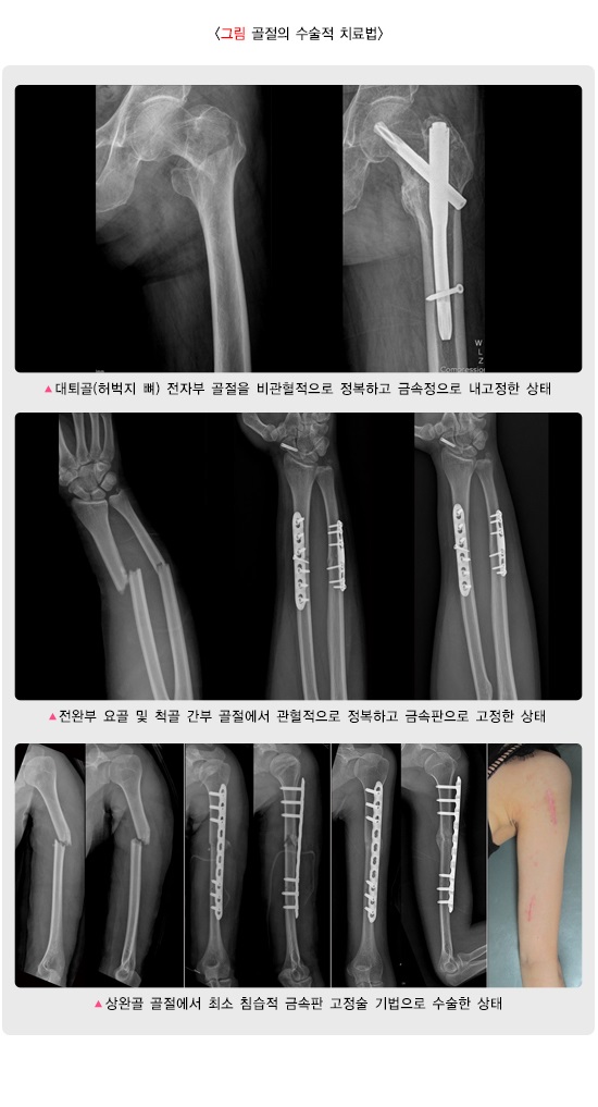 안산정형외과 골절 치료