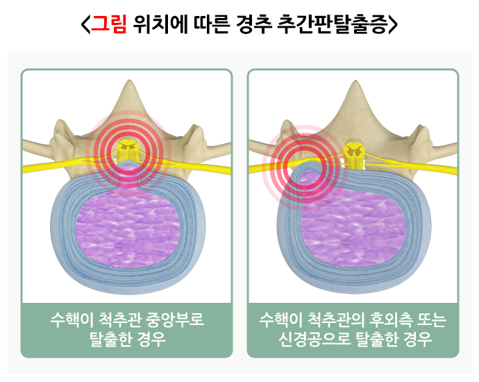 안산허리디스크